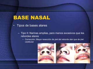 BASE NASAL
• Tipos de bases alares
– Tipo II: Narinas amplias, pero menos excesivos que los
rebordes alares
• Corrección: Mayor resección de piel del reborde alar que de piel
vestibular
 