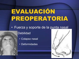 EVALUACIÓN
PREOPERATORIA
• Fuerza y soporte de la punta nasal
– Debilidad
• Colapso nasal
• Deformidades
 
