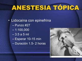 ANESTESIA TÓPICA
• Lidocaína con epinefrina
– Punzo #27
– 1:100,000
– 3.5 a 5 ml
– Esperar 10-15 min
– Duración 1.5- 2 horas
 