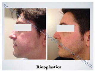 Rinoplastica Roma | Chirurgo Plastico Raffaele Rauso | PDF