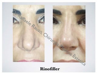 Rinoplastica Roma | Chirurgo Plastico Raffaele Rauso | PDF