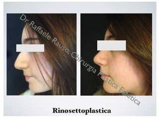 Rinoplastica Roma | Chirurgo Plastico Raffaele Rauso | PDF