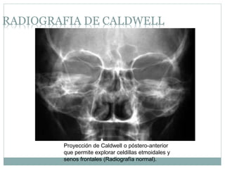 RADIOGRAFIA DE CALDWELL
Proyección de Caldwell o póstero-anterior
que permite explorar celdillas etmoidales y
senos frontales (Radiografía normal).
 