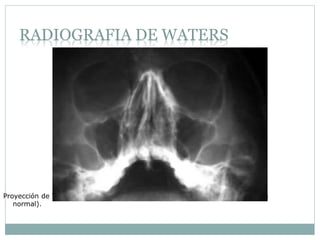 RADIOGRAFIA DE WATERS
Proyección de Waters u occipito-mentoniana para senos maxilares (Radiografía
normal).
 
