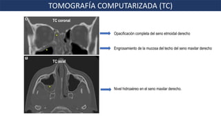 Nivel hidroaéreo en el seno maxilar derecho.
TC coronal
TC axial
Opacificación completa del seno etmoidal derecho
Engrosamiento de la mucosa del techo del seno maxilar derecho
TOMOGRAFÍA COMPUTARIZADA (TC)
 