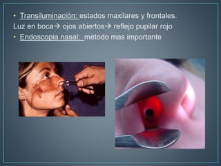 • Transiluminación: estados maxilares y frontales.
Luz en boca ojos abiertos reflejo pupilar rojo
• Endoscopia nasal: método mas importante
 