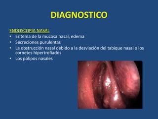 DIAGNOSTICO
ENDOSCOPIA NASAL
• Eritema de la mucosa nasal, edema
• Secreciones purulentas
• La obstrucción nasal debido a la desviación del tabique nasal o los
cornetes hipertrofiados
• Los pólipos nasales

 