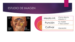 ESTUDIO DE IMAGEN
Meato inf.
Punción
Cultivar
•Toma directa
•Meato ½*
•S. maxilar
•“fosa canina”
•Secreción
 
