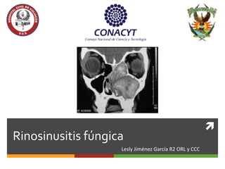 
Rinosinusitis fúngica
Lesly Jiménez García R2 ORL y CCC
 