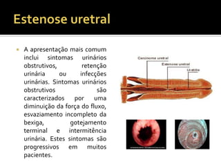  A apresentação mais comum
inclui sintomas urinários
obstrutivos, retenção
urinária ou infecções
urinárias. Sintomas urinários
obstrutivos são
caracterizados por uma
diminuição da força do fluxo,
esvaziamento incompleto da
bexiga, gotejamento
terminal e intermitência
urinária. Estes sintomas são
progressivos em muitos
pacientes.
 