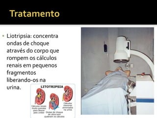  Liotripsia: concentra
ondas de choque
através do corpo que
rompem os cálculos
renais em pequenos
fragmentos
liberando-os na
urina.
 