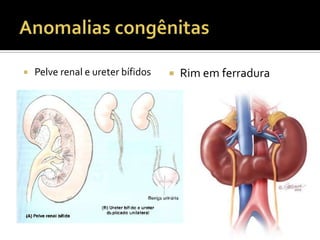  Pelve renal e ureter bífidos  Rim em ferradura
 