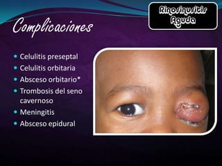  Celulitis preseptal
 Celulitis orbitaria
 Absceso orbitario*
 Trombosis del seno
  cavernoso
 Meningitis
 Absceso epidural
 