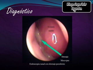 Endoscopia nasal con drenaje purulento
 