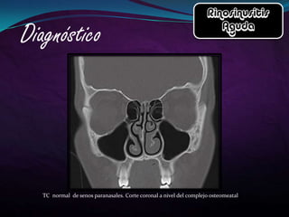 TC normal de senos paranasales. Corte coronal a nivel del complejo osteomeatal
 