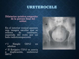 Dilatacion quistica congenita
de la porcion final del
uréter.
En el interior vesical aparece
una imagen sacular que se
rellena de contraste,
separada del resto por un
halo radiotransparente
 I Simple (25%) en
adultos
 II Ectópico (75%) se asocia
a duplicación, unilateral
(80%)
 