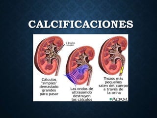 CALCIFICACIONES
 