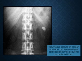Voluminoso cálculo en el riñón
izquierdo, así como múltiples
calcificaciones más pequeñas
en ambos riñones.
 