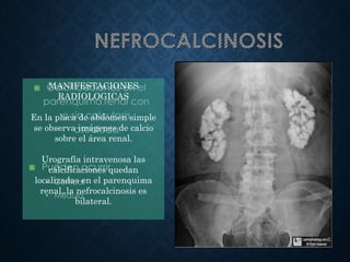 Calcificaciones en el
parénquima renal con
o sin calculosis
asociada
Pueden ocurrir
• Cortical
• Médula Rx simple abdomen: Nefrocalcinosis
bilateral
MANIFESTACIONES
RADIOLOGICAS
En la placa de abdomen simple
se observa imágenes de calcio
sobre el área renal.
Urografía intravenosa las
calcificaciones quedan
localizadas en el parenquima
renal,.la nefrocalcinosis es
bilateral.
 