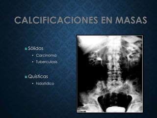 Sólidas
• Carcinoma
• Tuberculosis
Quísticas
• hidatídico
 