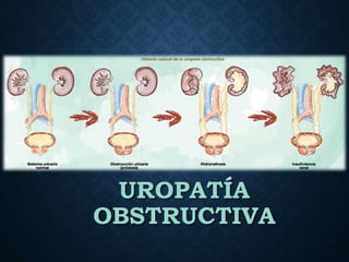UROPATÍA
OBSTRUCTIVA
 