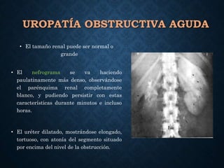 UROPATÍA OBSTRUCTIVA AGUDA
• El tamaño renal puede ser normal o
grande
• El nefrograma se va haciendo
paulatinamente más denso, observándose
el parénquima renal completamente
blanco, y pudiendo persistir con estas
características durante minutos e incluso
horas.
• El uréter dilatado, mostrándose elongado,
tortuoso, con atonía del segmento situado
por encima del nivel de la obstrucción.
 