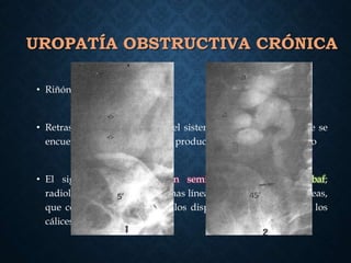 UROPATÍA OBSTRUCTIVA CRÓNICA
• Riñón aumentado de tamaño
• Retraso en la opacificación del sistema colector dilatado, que se
encuentra repleto de orina, se produce un pielograma negativo
• El signo de los cálices en semiluna, anillos de Dunbaf;
radiológicamente aparecen unas líneas difusas, finas, curvilíneas,
que corresponden a los túbulos dispuestos paralelamente a los
cálices dilatados.
 