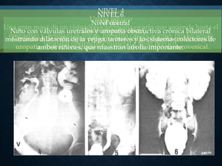 NIVEL 4
Uréter pélvico
Una gran masa de un cistoadenocarcinoma ovario que asciende hasta el
epigastrio y desplaza la vejiga, presenta calcificaciones produciendo
uropatia obstructiva bilateral a nivel pélvico.
NIVEL 5
Unión ureterovesical
Carcinoma de vejiga que presenta una vejiga pequeña produciendo
uropatia obstructiva izquierda a nivel de la unión ureterovesical.
NIVEL 6
Nivel uretral
Niño con válvulas uretrales y uropatia obstructiva crónica bilateral
mostrando dilatación de la vejiga, uréteres y los sistemas colectores de
ambos riñones, que muestran atrofia importante.
 