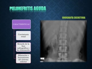 CARACTERÍSTICAS:
Crecimiento
renal
Retardo de la
fase
nefrográfica y
de eliminación
Dilatación o
borramiento
del sistema
colector
UROGRAFÍA EXCRETORA
 