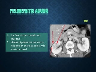 TAC
1. La fase simple puede ser
normal
2. Áreas hipodensas de forma
triangular entre la papila y la
corteza renal
 