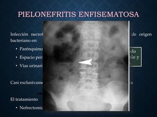 Infección necrotizante de los riñones. Presencia de gas de origen
bacteriano en:
• Parénquima renal
• Espacio perirrenal
• Vías urinarias
Casi exclusivamente en diabéticos y/o con uropatía obstructiva
El tratamiento agresivo
• Nefrectomía
TAC método
mas confiable y
sensible.
 