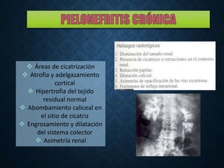  Áreas de cicatrización
 Atrofia y adelgazamiento
cortical
 Hipertrofia del tejido
residual normal
 Abombamiento caliceal en
el sitio de cicatriz
 Engrosamiento y dilatación
del sistema colector
 Asimetría renal
 