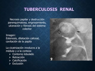 Necrosis papilar y destrucción
parenquimatosa, engrosamiento,
ulceración y fibrosis del sistema
colector
Imagen:
Estenosis, dilatación caliceal,
cavitación de la papila
La cicatrización involucra a la
médula y a la corteza:
 Contorno lobulado
 Retracción
 Calcificación
 Exclusión
 