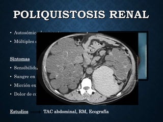 • Autosómico dominante
• Múltiples quistes en riñones
Síntomas
• Sensibilidad o dolor abdominal
• Sangre en la orina
• Micción excesiva durante la noche
• Dolor de costado en uno o ambos lados
Estudios TAC abdominal, RM, Ecografía
 