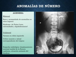 ANOMALÍAS DE NÚMERO
AGENESIA
Bilateral
Rara y acompañada de anomalías en
otros órganos.
Síndrome de Potter (cara,
extremidades, oligohidramnios)
Unilateral
Varones en riñón izquierdo
Uréter ausente y mitad
correspondiente del trígono
Sospecha radiológica: desplazamiento
anormal medial de la flexura
esplénica, situación anómala del
duodeno
 