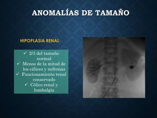 ANOMALÍAS DE TAMAÑO
HIPOPLASIA RENAL
 2/3 del tamaño
normal
 Menos de la mitad de
los cálices y nefronas
 Funcionamiento renal
conservado
 Cólico renal y
lumbalgia
 