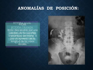 ANOMALÍAS DE POSICIÓN:
ECTOPIA simple
El ascenso excesivo
origina un riñón torácico,
situándose a la altura del
diafragma, pudiendo
producir una lobulación
en el mismo.
ECTOPIA CRUZADA
Cuando un riñón se sitúa
en el lado contrario
cruzando la línea media.
PTOSIS
Riñón descendido por una
perdida de los soportes
anatómicos del mismo o
por un aumento de la
longitud de los vasos
renales.
 