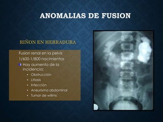ANOMALIAS DE FUSION
Fusion renal en la pelvis
1/600-1/800 nacimientos
Hay aumento de la
incidencia:
• Obstrucción
• Litiasis
• Infección
• Aneurisma abdominal
• Tumor de willms
RIÑON EN HERRADURA
 