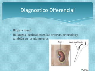 Diagnostico Diferencial

Biopsia Renal
Hallazgos localizados en las arterias, arteriolas y
también en los glomérulos.

 