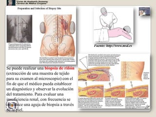 Biopsia Riñon Riñones segunda parte | PPTX