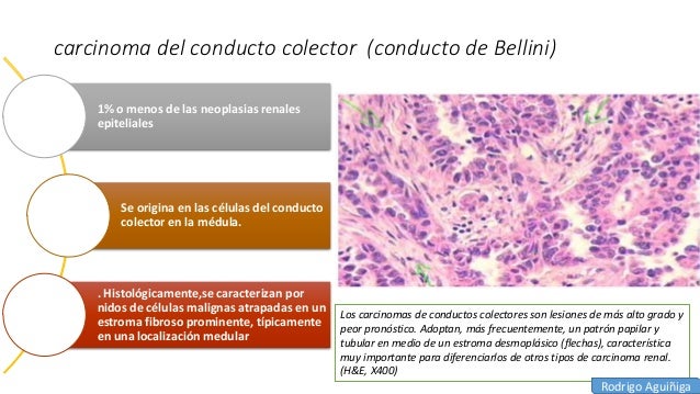 Carcinoma De Los Conductos Colectores De Bellini