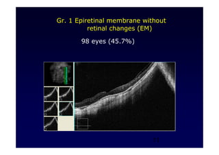 11
Gr. 1 Epiretinal membrane without
retinal changes (EM)
98 eyes (45.7%)
 