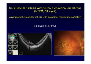 12
Gr. 2 Macular schisis with/without epiretinal membrane
(MSEM, 54 eyes)
Asymptomatic macular schisis with epiretinal membrane (AMSEM)
33 eyes (15.4%)
 