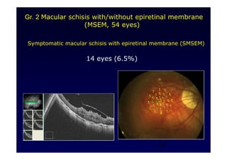 13
Symptomatic macular schisis with epiretinal membrane (SMSEM)
14 eyes (6.5%)
Gr. 2 Macular schisis with/without epiretinal membrane
(MSEM, 54 eyes)
 