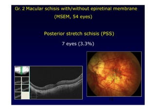 14
Posterior stretch schisis (PSS)
7 eyes (3.3%)
Gr. 2 Macular schisis with/without epiretinal membrane
(MSEM, 54 eyes)
 