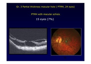 15
Gr. 3 Partial thickness macular hole ( PTMH, 24 eyes)
PTMH with macular schisis
15 eyes (7%)
 