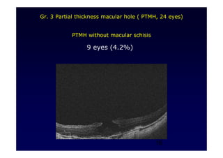 16
Gr. 3 Partial thickness macular hole ( PTMH, 24 eyes)
PTMH without macular schisis
9 eyes (4.2%)
 