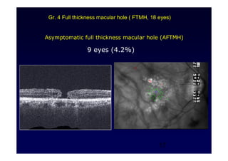 17
Asymptomatic full thickness macular hole (AFTMH)
9 eyes (4.2%)
Gr. 4 Full thickness macular hole ( FTMH, 18 eyes)
 