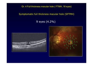 18
Symptomatic full thickness macular hole (SFTMH)
9 eyes (4.2%)
Gr. 4 Full thickness macular hole ( FTMH, 18 eyes)
 