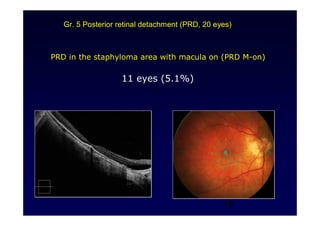 19
PRD in the staphyloma area with macula on (PRD M-on)
11 eyes (5.1%)
Gr. 5 Posterior retinal detachment (PRD, 20 eyes)
 